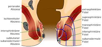 TREATMENT OF PILES