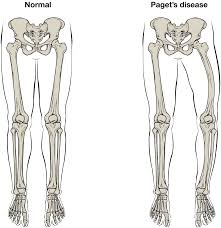 PAGET’S DISEASE