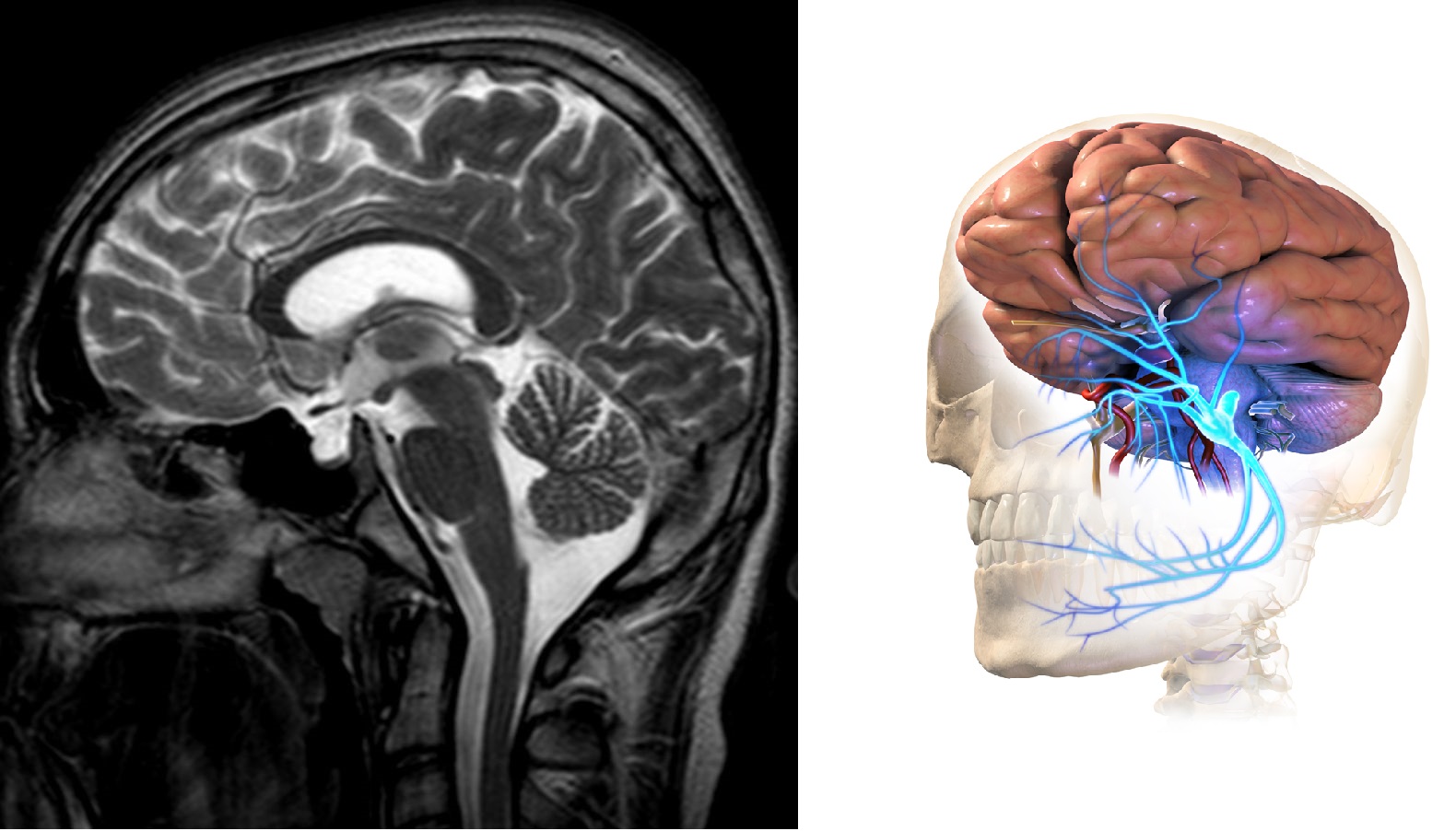 a-case-of-empty-sella-syndrome-with-trigeminal-neuralgia-cured-with