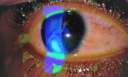 A CASE OF CORNEAL ULCER CURED WITH SENEGA