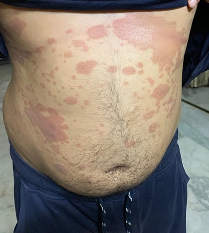 Psoriasis treated with homeopathy: A case report