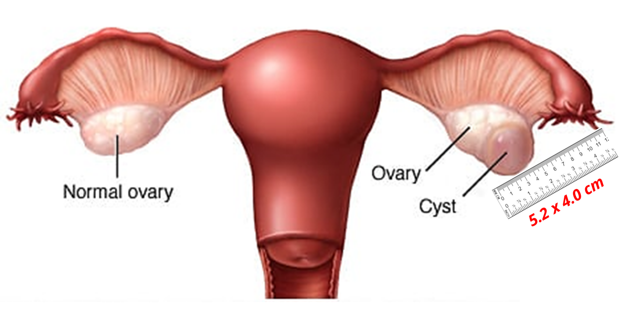 HEMORRHAGIC OVARIAN CYST TREATED WITH HOMEOPATHY: A CASE REPORT